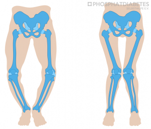 Beinachsenfehlstellung